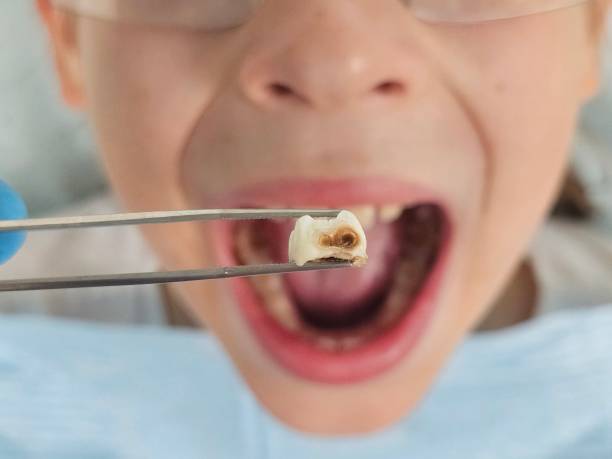 Best Emergency Wisdom Tooth Extraction in Chadbourn, NC